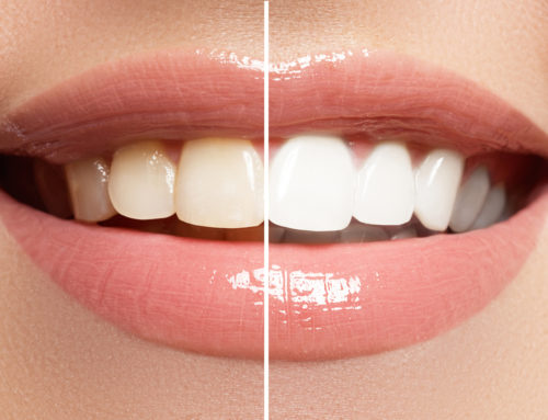 Bleaching für die Zähne: Kosten- und Gesundheitscheck